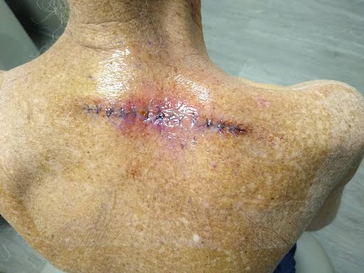 sutures during 1st bandage change